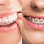 how does invisalign compare to traditional braces