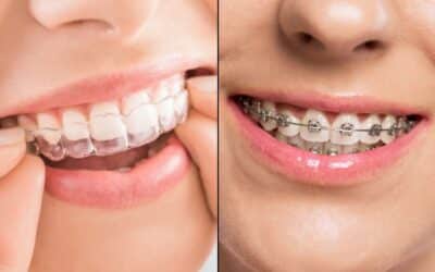 how does invisalign compare to traditional braces