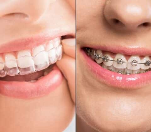 how does invisalign compare to traditional braces