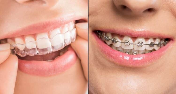 how does invisalign compare to traditional braces