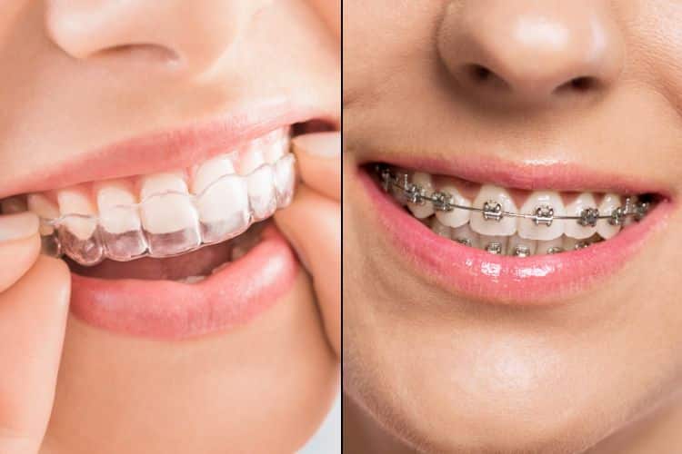 how does invisalign compare to traditional braces