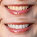 what are the best teeth whitening options in orange county ca