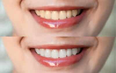 what are the best teeth whitening options in orange county ca