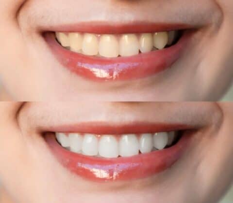 what are the best teeth whitening options in orange county ca