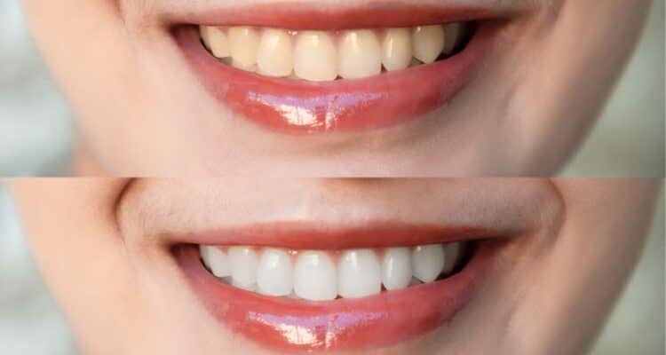 what are the best teeth whitening options in orange county ca