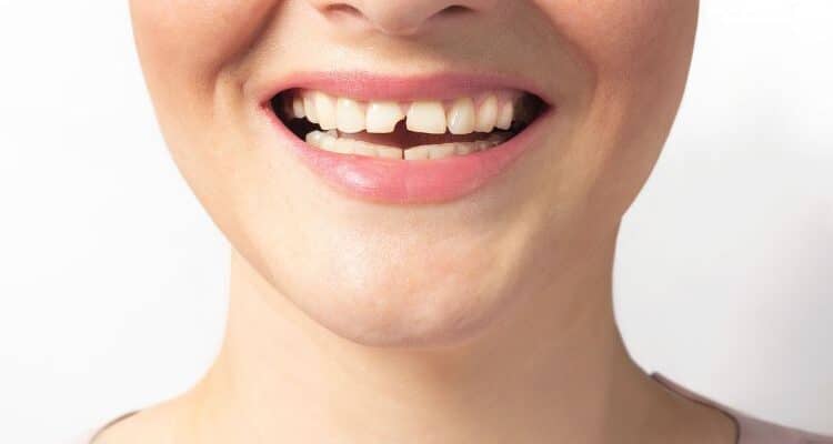 what are the best treatment options for a broken tooth