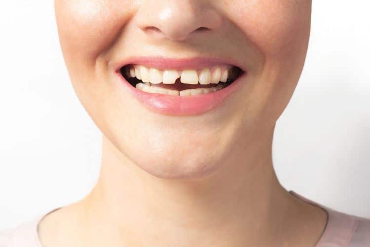 what are the best treatment options for a broken tooth