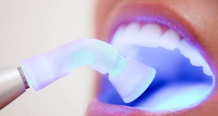 why composite fillings are the preferred choice for cavities