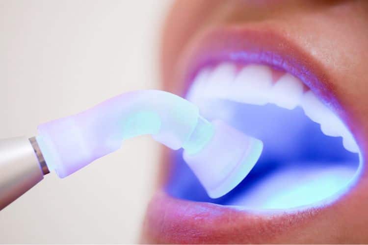 why composite fillings are the preferred choice for cavities